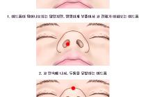 여드름, 가장 고통스터운 위치는?