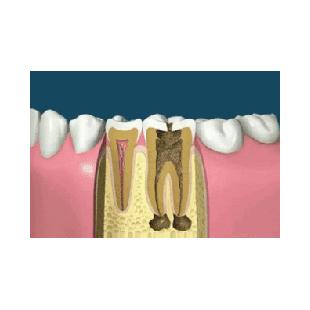 충치 신경치료 과정